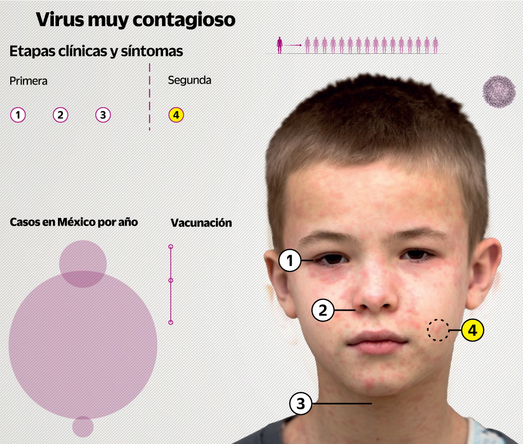 Tras la huella del sarampión